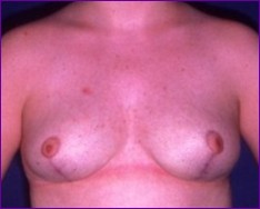 Breast reduction after surgery